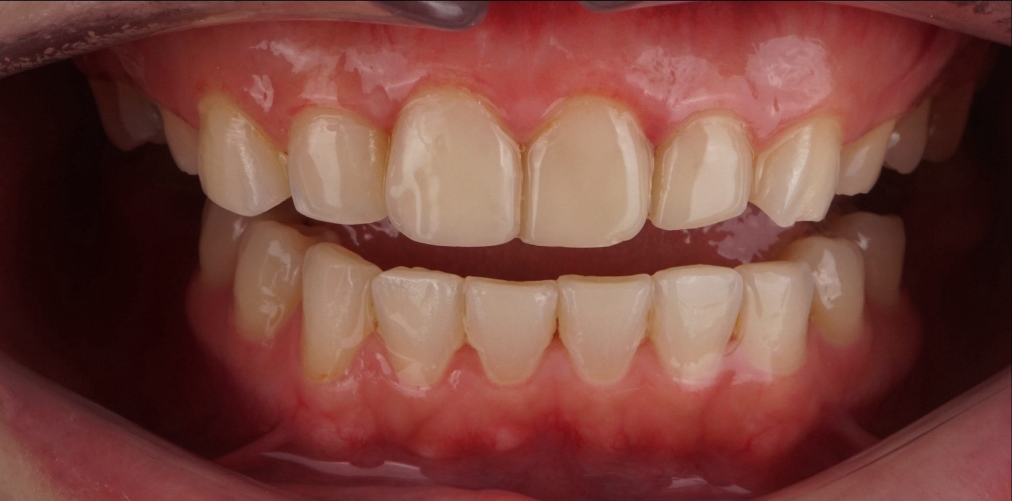 Before treatment