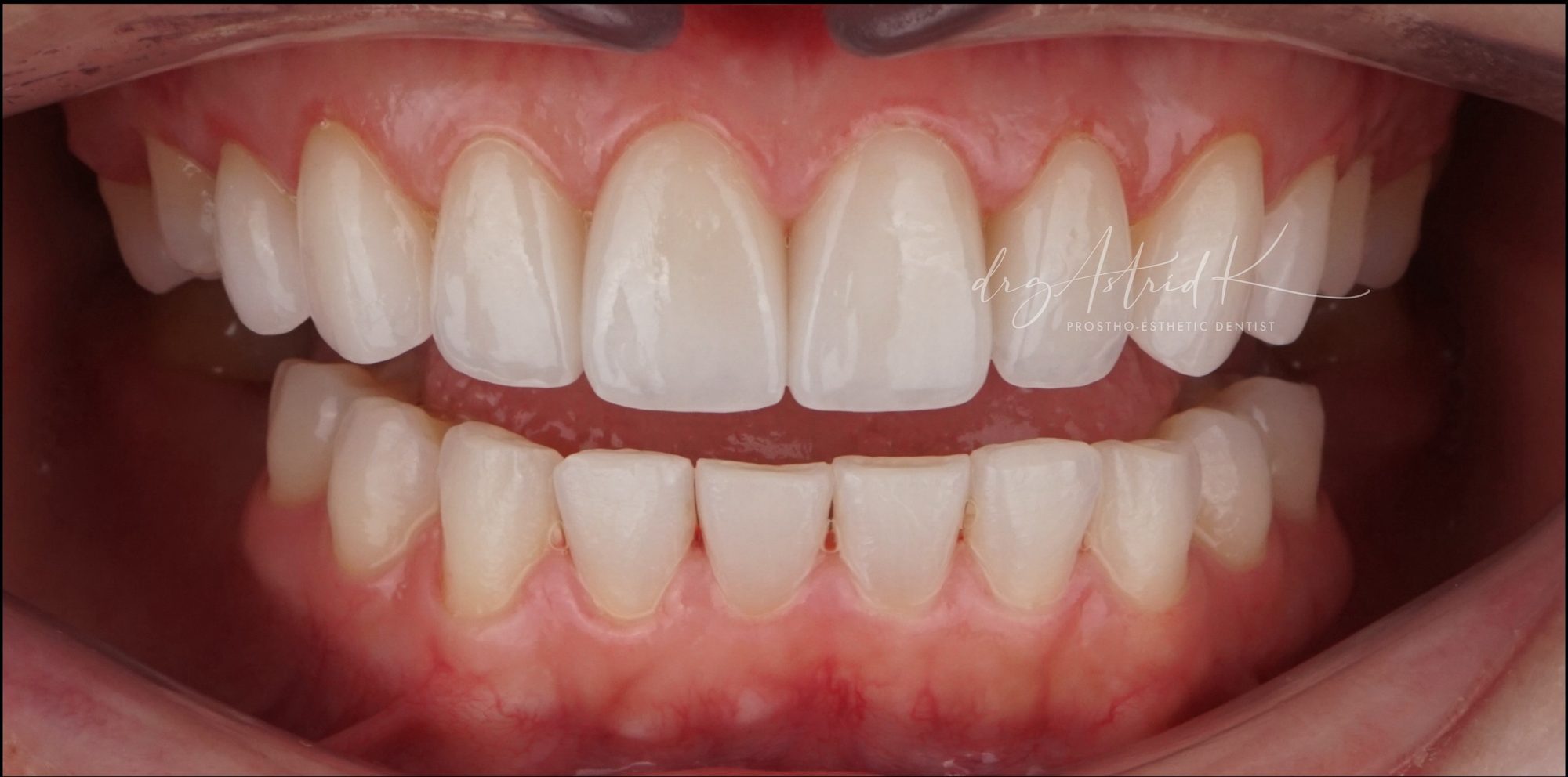 After treatment